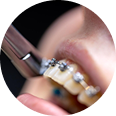 Orthodontics Coverage